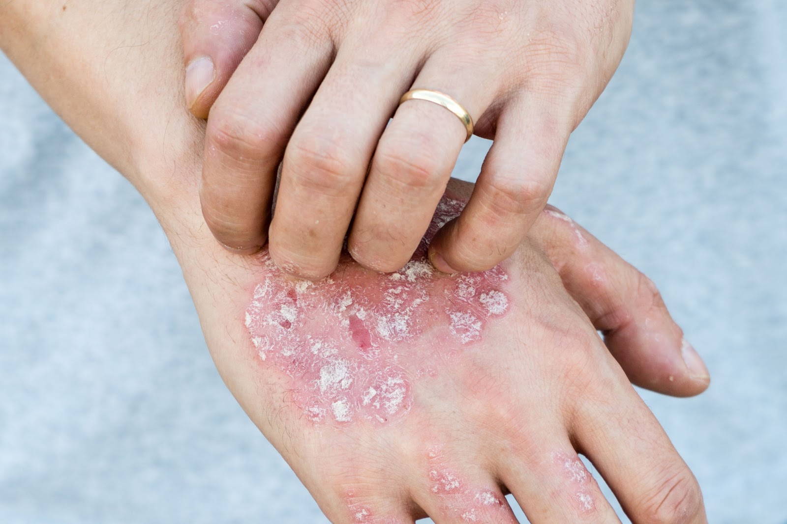 Managing Your Psoriasis Flare-Ups | Premier Dermatology | Delaware